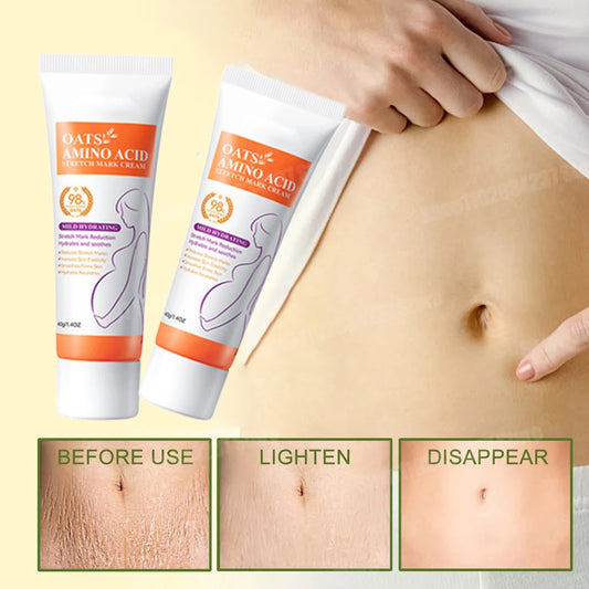 Stretch Marks Removal Cream