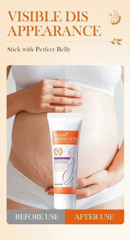 Stretch Marks Removal Cream