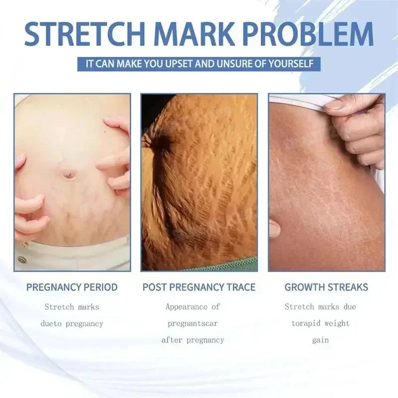 Stretch Marks Removal Cream