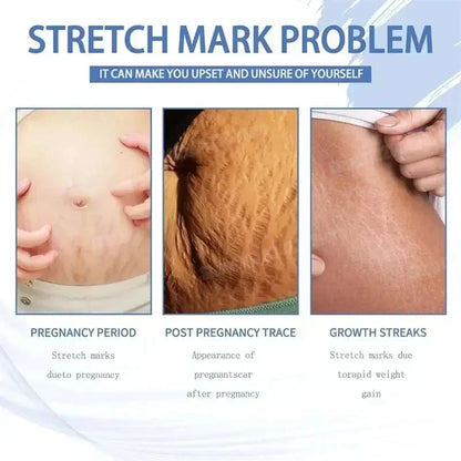 Stretch Marks Removal Cream