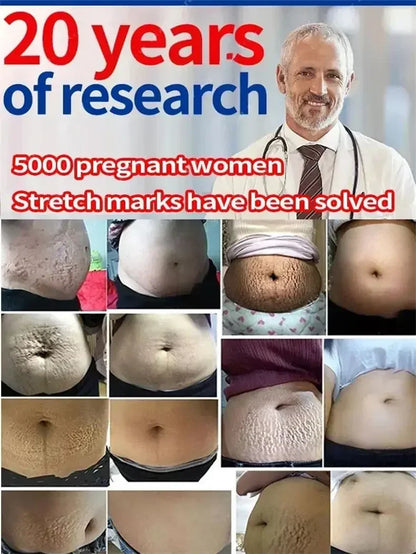 Stretch Marks Removal Cream