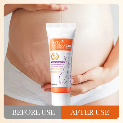 Stretch Marks Removal Cream